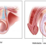 hidrokela