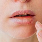 Close,Up,Of,Girl,Lips,Affected,By,Herpes.,Treatment,Of