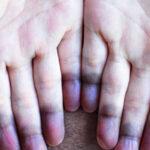 Inside_cyanosis2